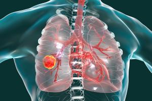 Cycle : Dépistage du cancer du poumon par scanner à faible dose